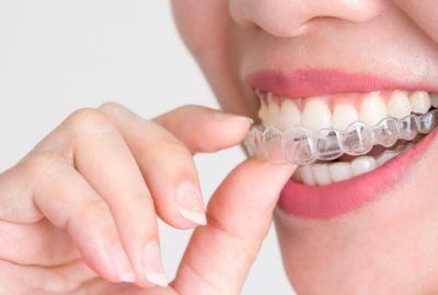 Dental Aligners